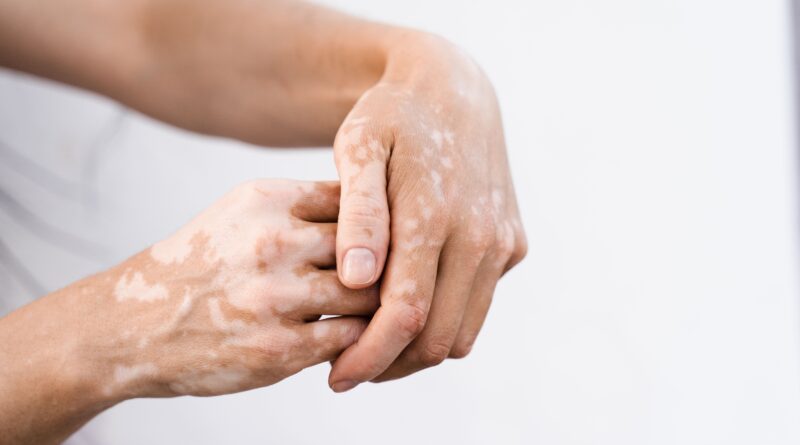 Patients With Vitiligo Have Poorer Quality of Life but Greater Health Experience, Use